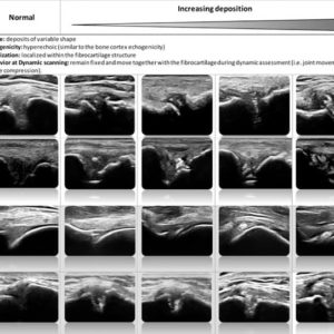 US and CPPD - INTERNATIONAL SOCIETY FOR ULTRASOUND IN RHEUMATOLOGY